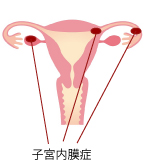 子宮内膜